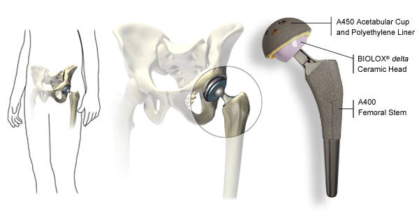 hip-replacement3